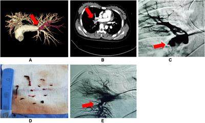 Combined endovascular interventions for pulmonary embolism at high altitude in Tibet